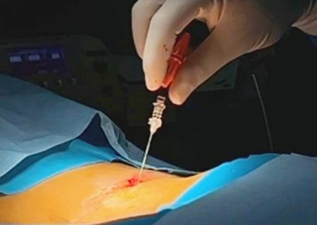 نخستین جراحی لیزری دیسک کمر در بیمارستان کنگان انجام شد